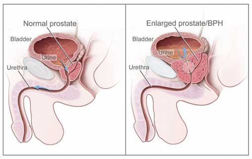 Treat Prostate Enlargement