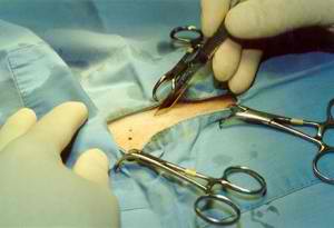 Male Enhancement Surgery